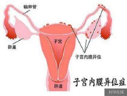 子宫内膜异位症