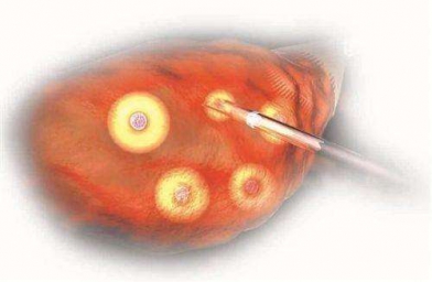 福建格鲁吉亚Innova医院专家解释促排卵有几种方式？