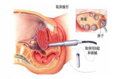 福建“二孩政策”致浙江试管婴儿激增，但费用和成功率不成正比